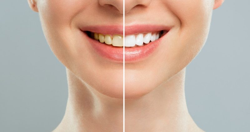 Top 12 Secrets To Whiter Teeth
